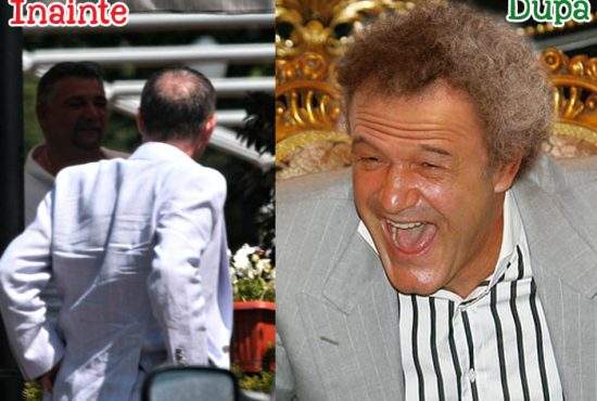 A scăpat de chelie! Gigi Becali îşi face implant de lână