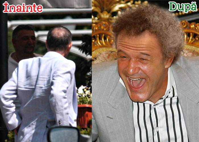 A scăpat de chelie! Gigi Becali îşi face implant de lână