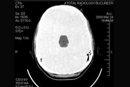 Şoc în lumea medicală! Unui jandarm i-a apărut creier pe tomografie