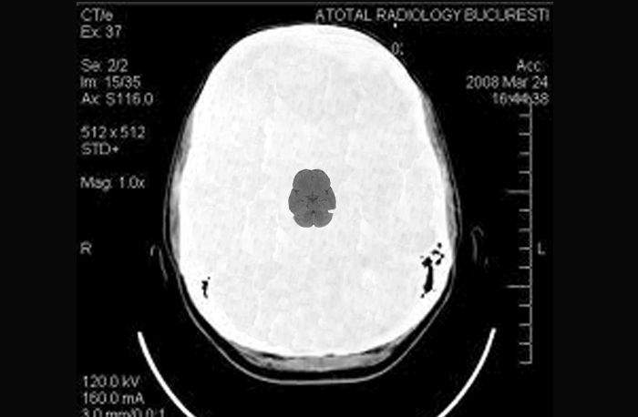 Şoc în lumea medicală! Unui jandarm i-a apărut creier pe tomografie