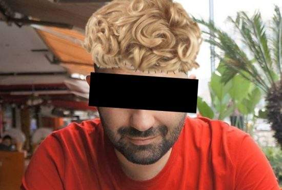 Un român a inventat implantul de păr low-cost! Şi-a cusut peruca de cap
