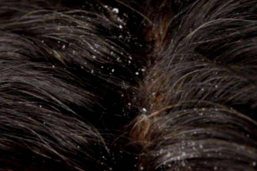 7 metode ca să scapi de mătreață