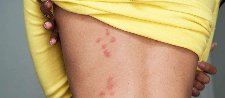 Tânăra mușcată de ploșnițe într-un tren CFR a fost dusă la spital unde au mușcat-o alte ploșnițe