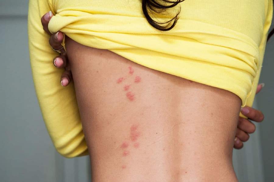 Tânăra mușcată de ploșnițe într-un tren CFR a fost dusă la spital unde au mușcat-o alte ploșnițe